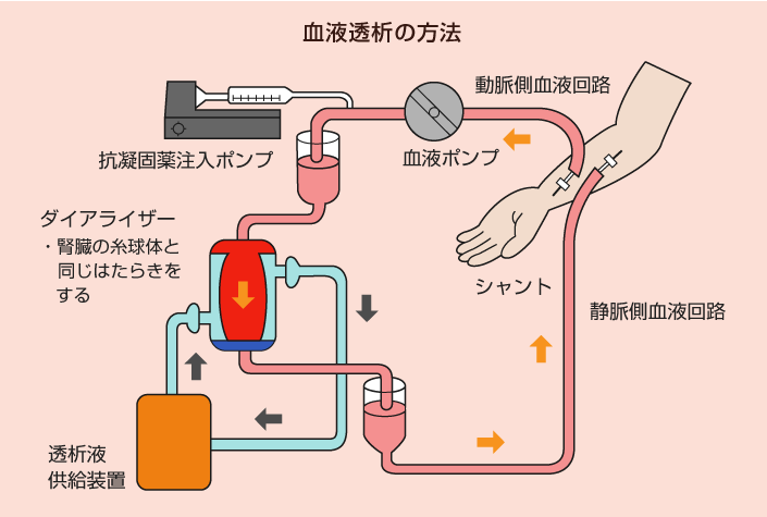 血液透析の方法